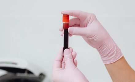 Marcadores tumorais: qual o papel na detecção precoce do câncer?